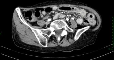 Case Report: A rare case of small bowel obstruction secondary to plasma cell myeloma